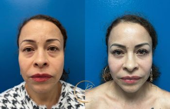 Side-by-side comparison of a woman's face before and after a cosmetic treatment, showing changes in fullness and wrinkles.