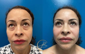 Side-by-side comparison of a woman's face before and after a cosmetic procedure, featuring reduced under-eye bags and smoother skin.
