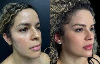 Side-by-side images of a woman before and after cosmetic enhancement, showing changes in skin texture, contour, and eyebrow shaping.