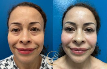 Before and after photos of a woman against a blue background, showing changes in facial appearance.