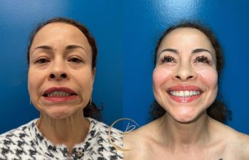 Before and after comparison of a woman smiling, showing changes in facial expression and makeup, against a blue background.