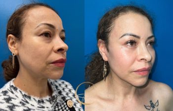 Side-by-side image comparison of the same person before and after a cosmetic procedure. The person has medium-length hair and is wearing earrings. The background is a solid blue color.