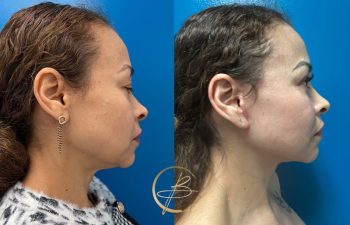 Side-by-side images of a woman's profile before and after a cosmetic procedure, set against a blue background. The "after" image shows a more defined jawline and smoother skin.