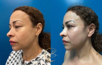 Side-by-side before and after images of a woman showing changes in her facial appearance, with a blue background.