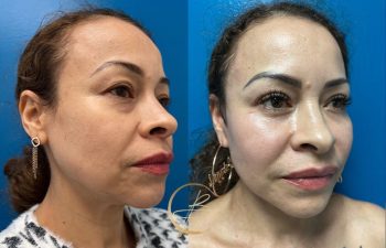 Side-by-side before and after images of a woman showing cosmetic changes, including fuller lips and smoother skin.