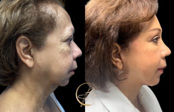 Side-by-side comparison of a woman's face in profile before and after cosmetic treatment, highlighting changes in skin texture and contour.