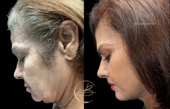 Side-by-side comparison of a woman before and after a cosmetic procedure, showing changes in skin tightness and hair color.