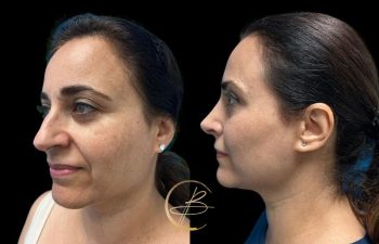 Before and after comparison of a woman's face, showing improvements in skin texture and jawline definition from different angles, on a black background.