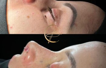 Close-up of a person's face before and after a cosmetic procedure, showing clearer skin and enhanced features in the second image.