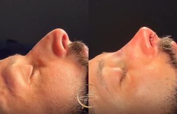 Side-by-side comparison of a person's profile, showing a nose before (left) and after (right) a rhinoplasty procedure.