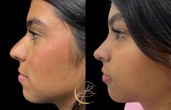 Side-by-side comparison of a woman's profile before and after a cosmetic procedure, highlighting changes in the nose and chin.
