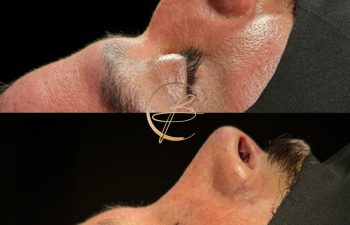 Comparison of a person's profile, showing a nose before and after a rhinoplasty procedure.